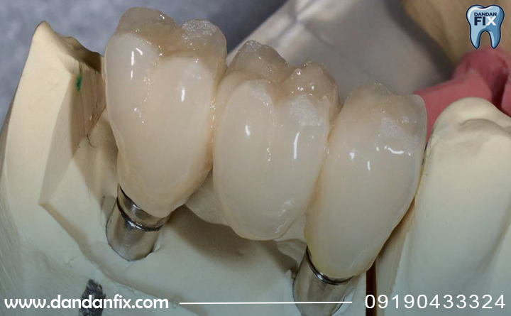 بریج برپایه ایمپلنت