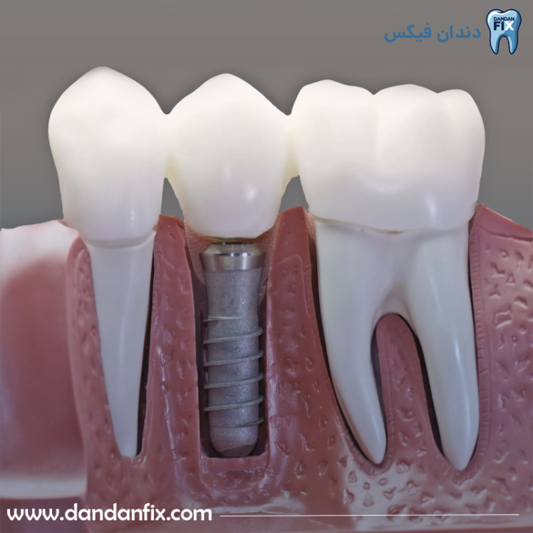 ایمپلنت تک دندان چیست؟ مراحل کاشت ایمپلنت تک عددی و قیمت آن