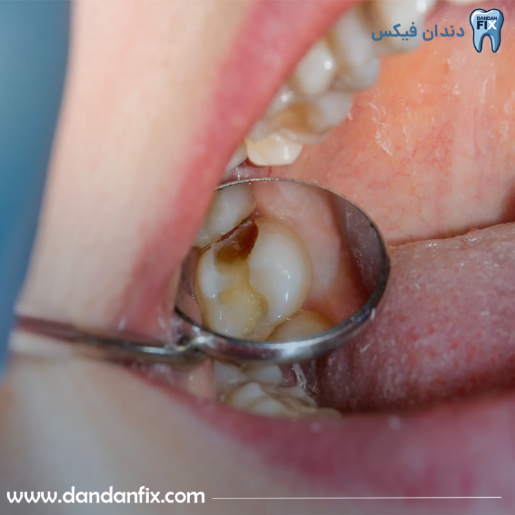 آیا دندان ایمپلنت شده خراب میشود؟