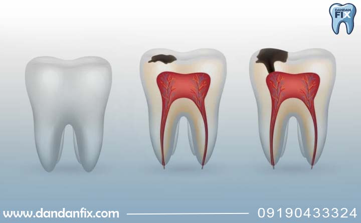 مراحل پوسیدگی دندان