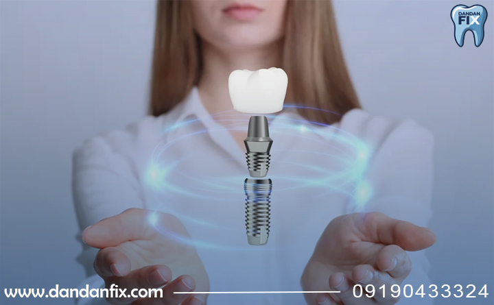 قیمت ایمپلنت اشترومن