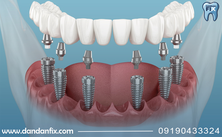 All-on-6 پروتز مصنوعی