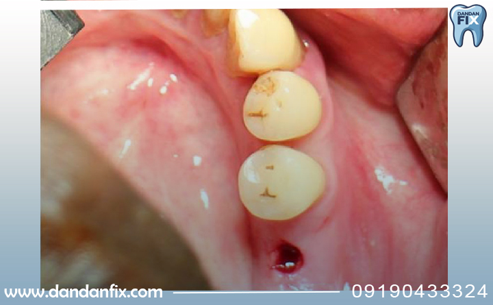 مراحل ایمپلنت پانچ