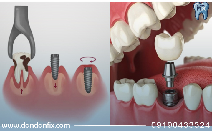 ایمپلنت فوری