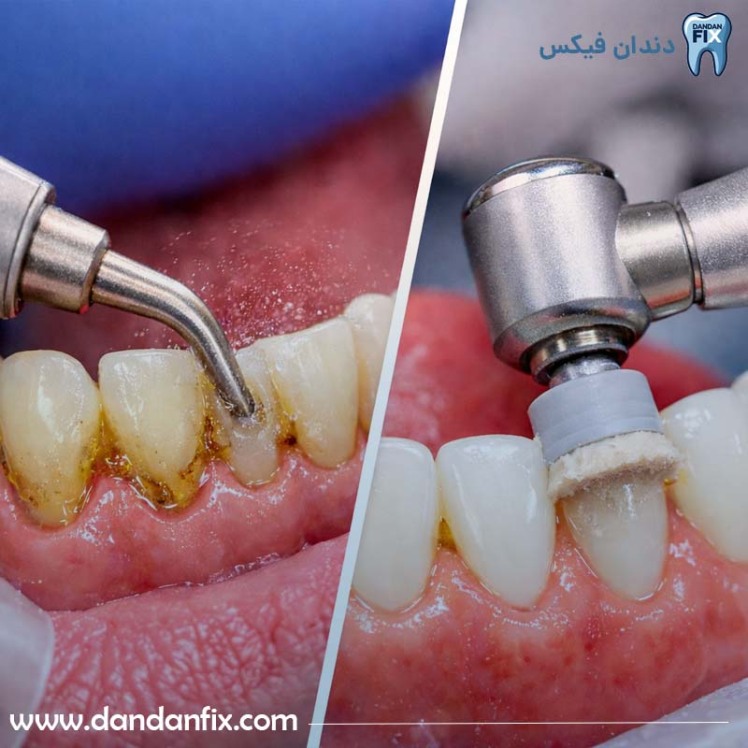 تفاوت جرم گیری دندان و بروساژ دندان چیست؟