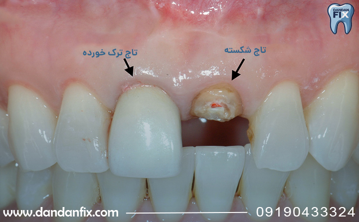 کی ایمپلنتم را عوض کنم؟