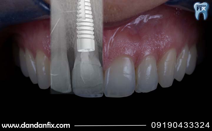 ایمپلنت نوبل امریکا