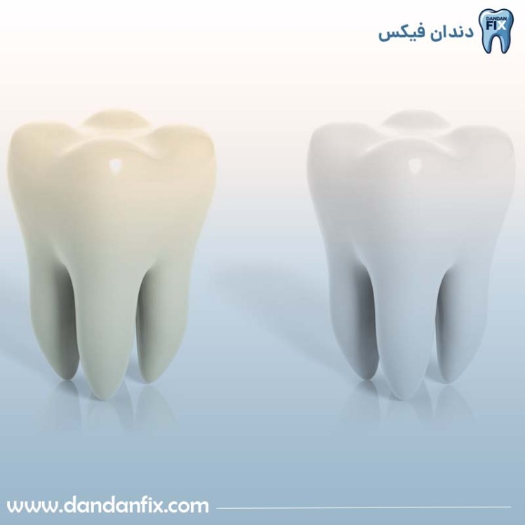 بلیچینگ دندان + بلیچینگ دندان چقدر دوام دارد؟