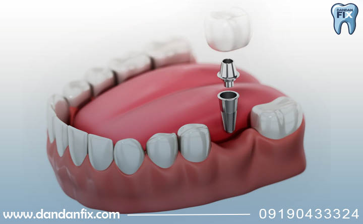 ایمپلنت تک مرحله ای