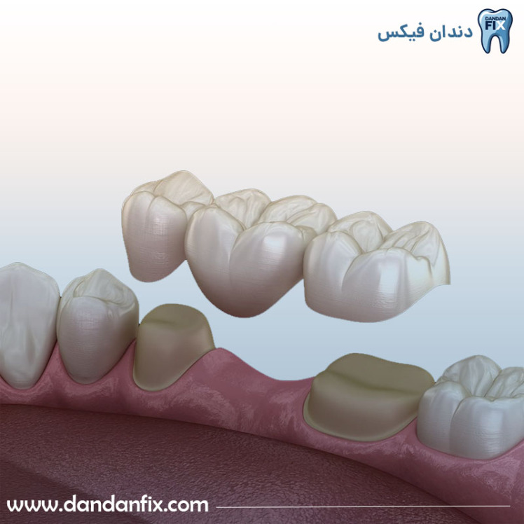 بریج دندان چیست؟ نحوه انجام بریج و طول عمر آن
