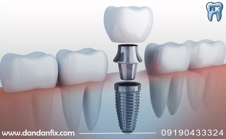 موفقیت بیشتر ایمپلنت معمولی