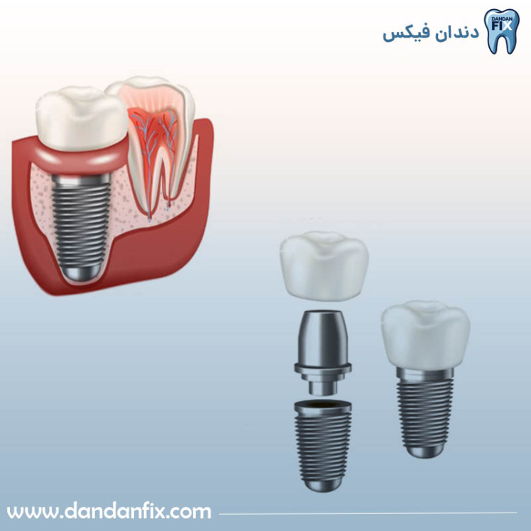 ایمپلنت دندان چیست؟ مراحل کاشت دندان دائمی 