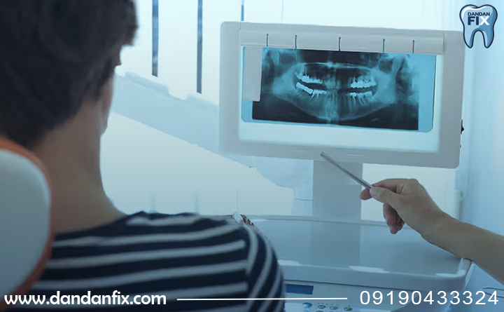 طولانی شدن زمان ایمپلنت دندان