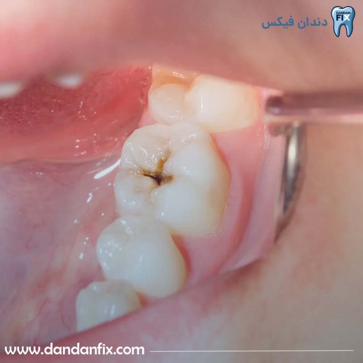 علل پوسیدگی دندان چیست؟ پیشگیری و درمان پوسیدگی