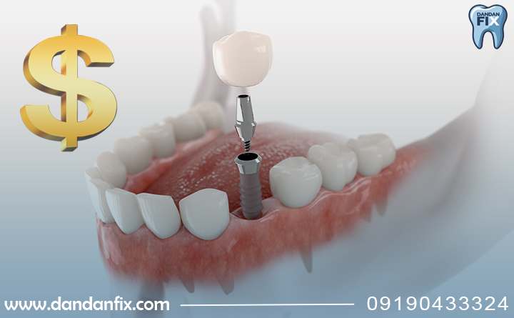 قیمت ایمپلنت فوری