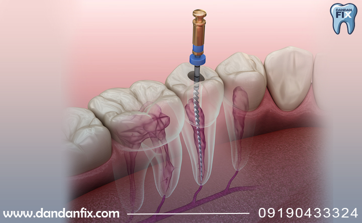 عصب کشی دندان