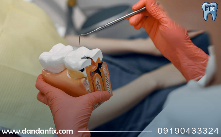 ضرورت عصب کشی