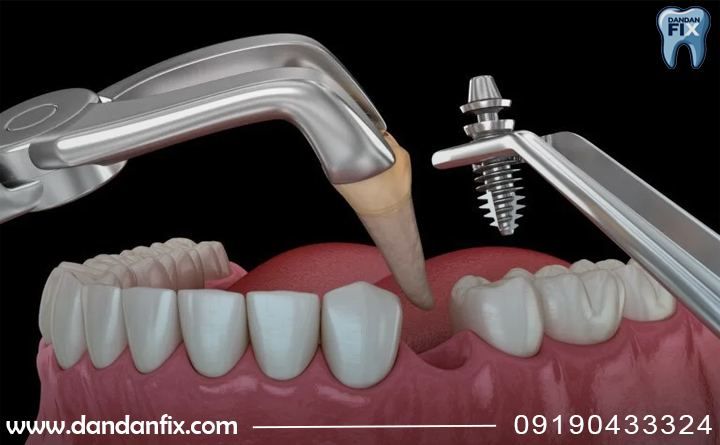 ایمپلنت فوری چقدر طول میکشه؟
