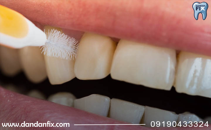 مسواک زدن دندان ایمپلنت شده