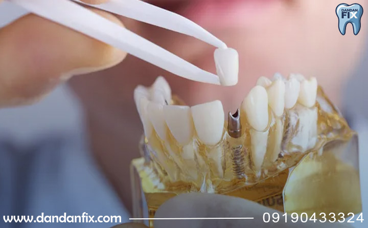 سرعت انجام ایمپلنت فوری