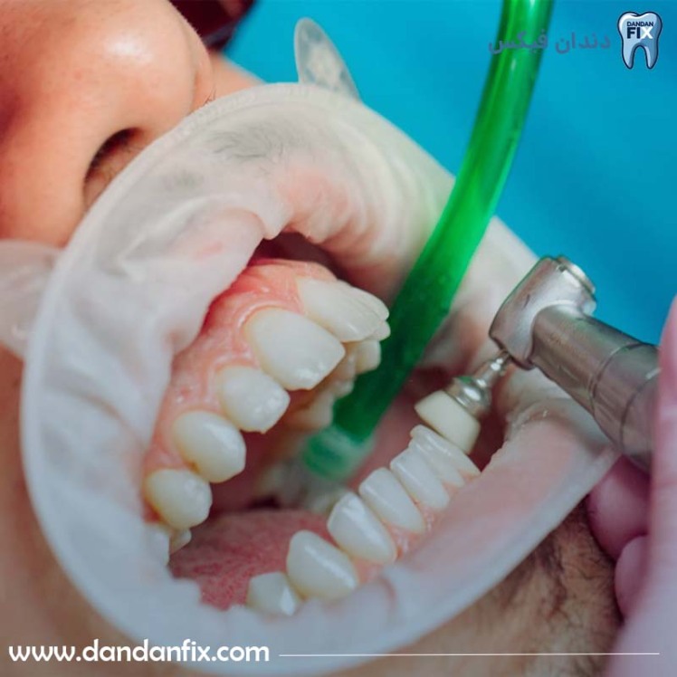 جرم گیری دندان چیست و چگونه انجام میشود؟