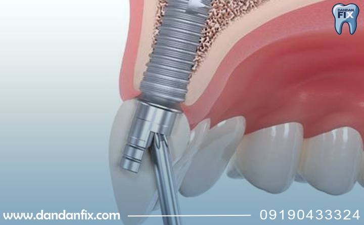 انتخاب مدنتیکا