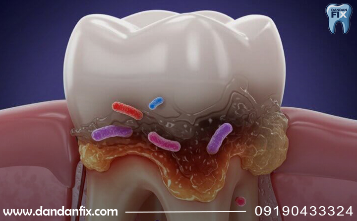 عفونت دندان