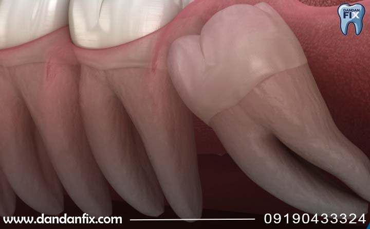 کشیدندندان عقل