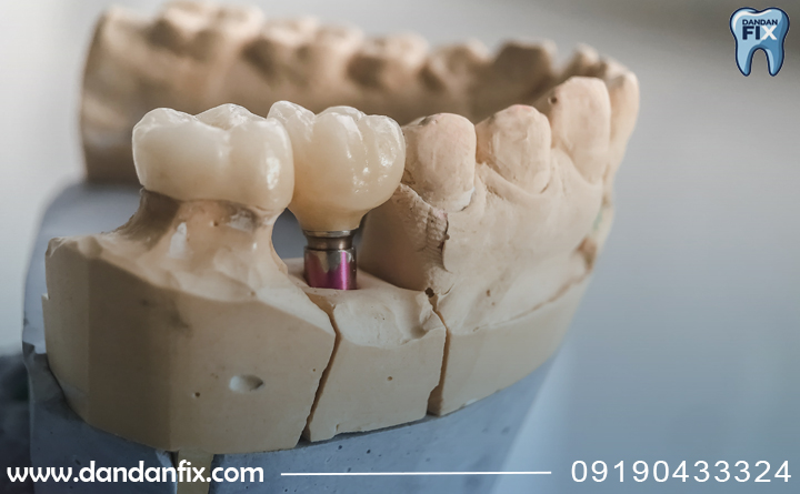 مراقبت پس از کاشت ایمپلنت