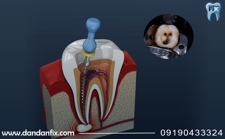 عصب کشی چقدر طول میکشه؟