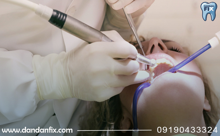 جرم گیری ایمپلنت توسط دندانپزشک