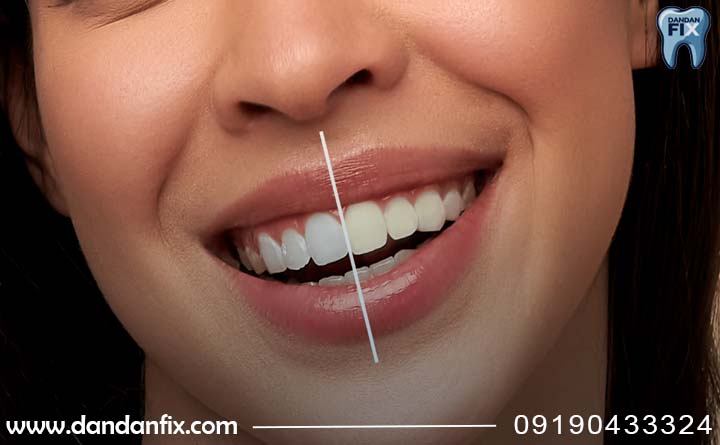 مزایا و عوارض بلیچینگ