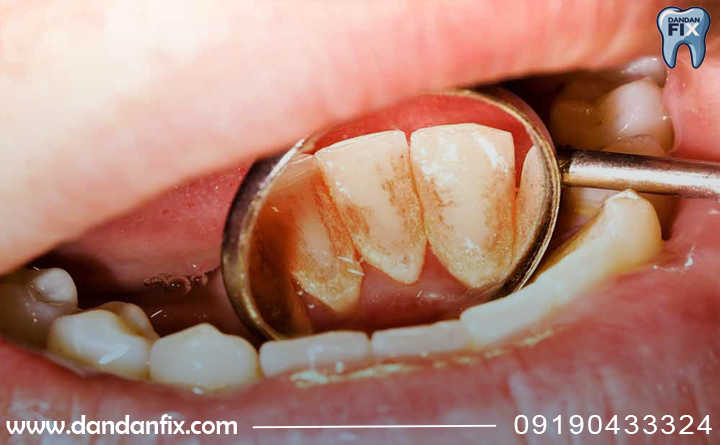 علل زرد شدن دندان