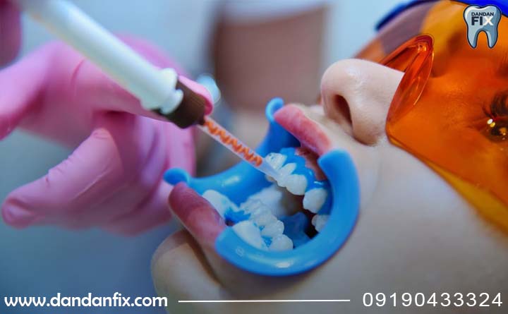 مراحل بلیچینگ