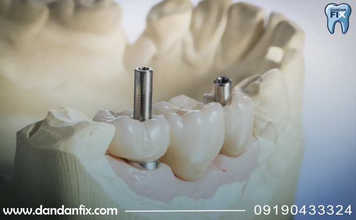 قیمت ایمپلنت مدنتیکا