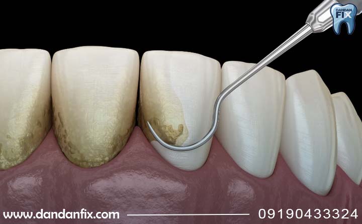 جرمگیری دندان