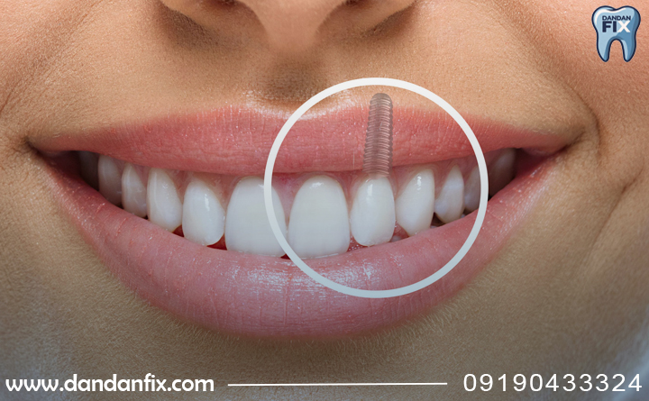 ایمپلنت دندان چقدر طول میکشد