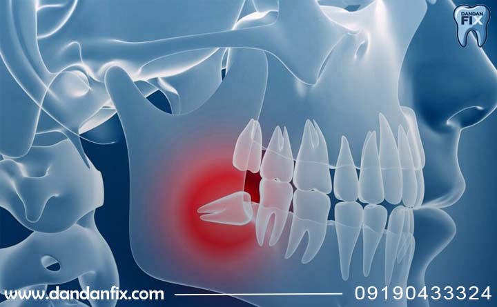 مدلهای نهفتگی دندان عقل