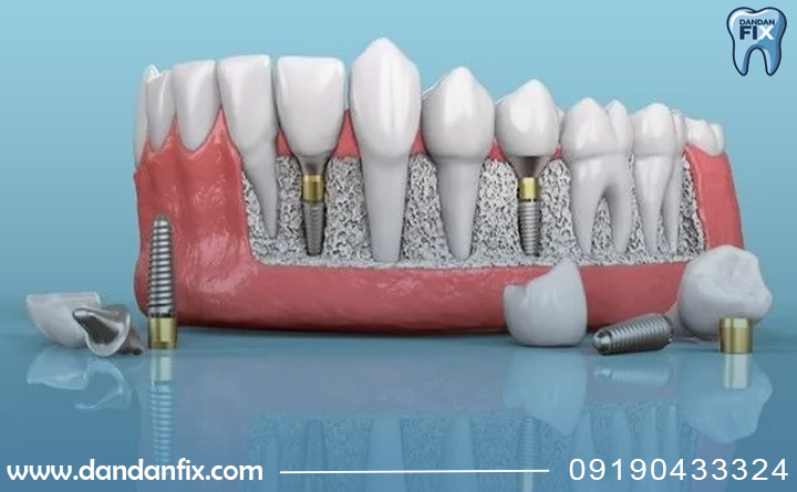 وضعیت لثه ها برای ایمپلنت