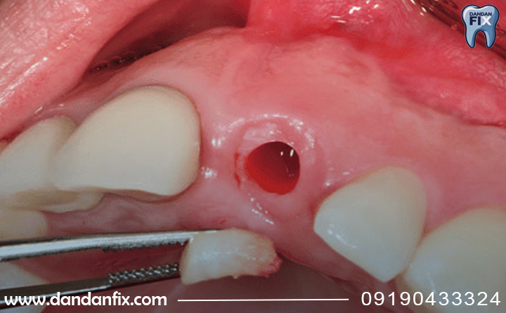 ایمپلنت پانچ 