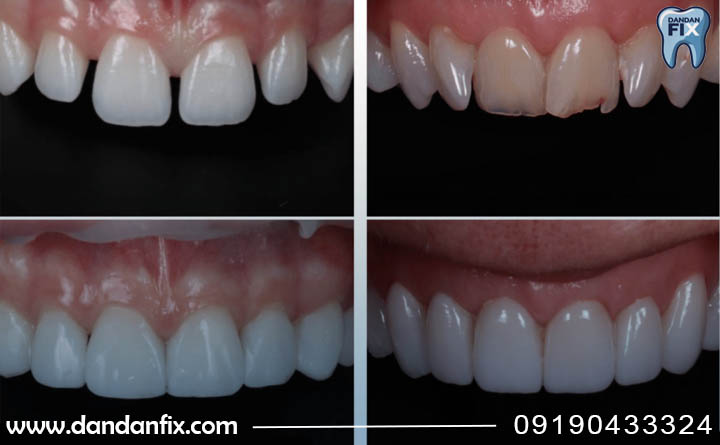 کامپوزیت دندان برای من مناسب است؟