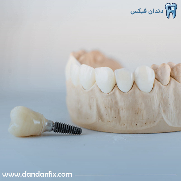 عوارض ایمپلنت دندان چیست؟