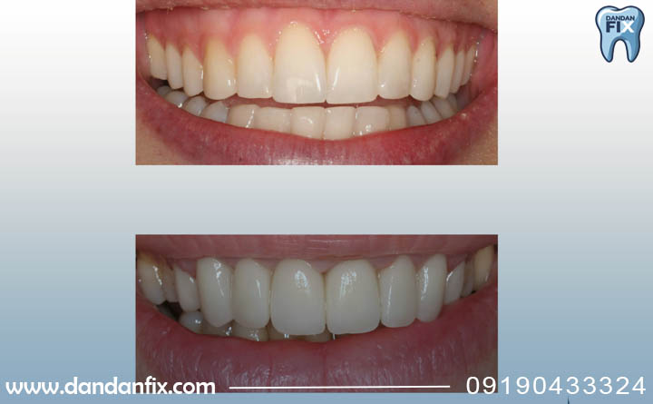 کامپوزیت چقدر عمر میکند؟