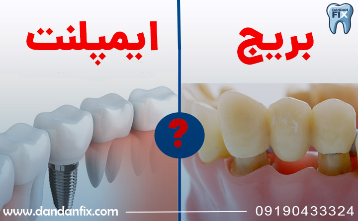 بریج دندان یا ایمپلنت؟