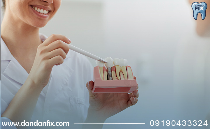 مزایای ایمپلنت مگاژن