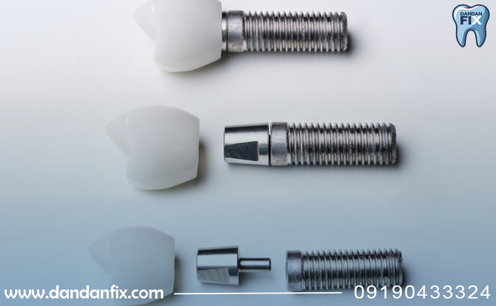 ویژگی‌های ایمپلنت نئودنت