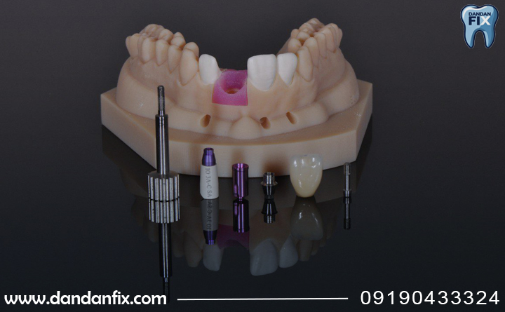 ایمپلنت دیجیتال یعنی چی؟