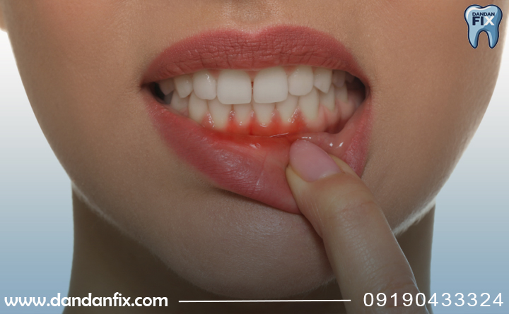 التهاب لثه پس از گذاشتن پروتز دندان