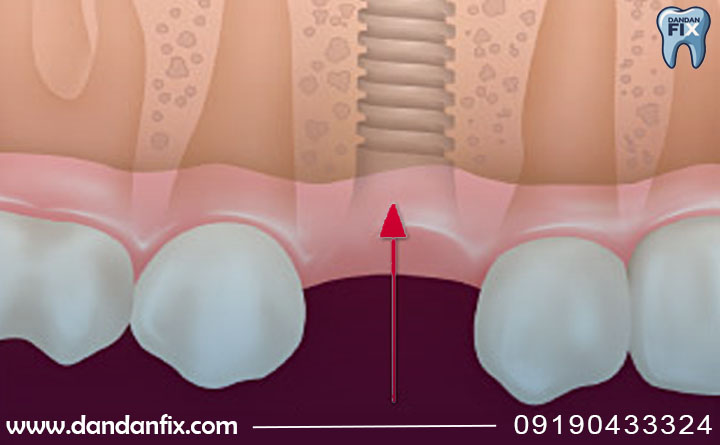 ایمپلنت دو مرحله ای