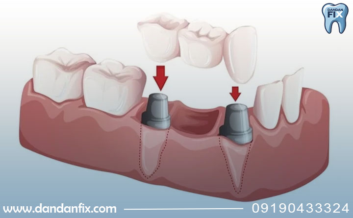 بریج دندان چیست؟